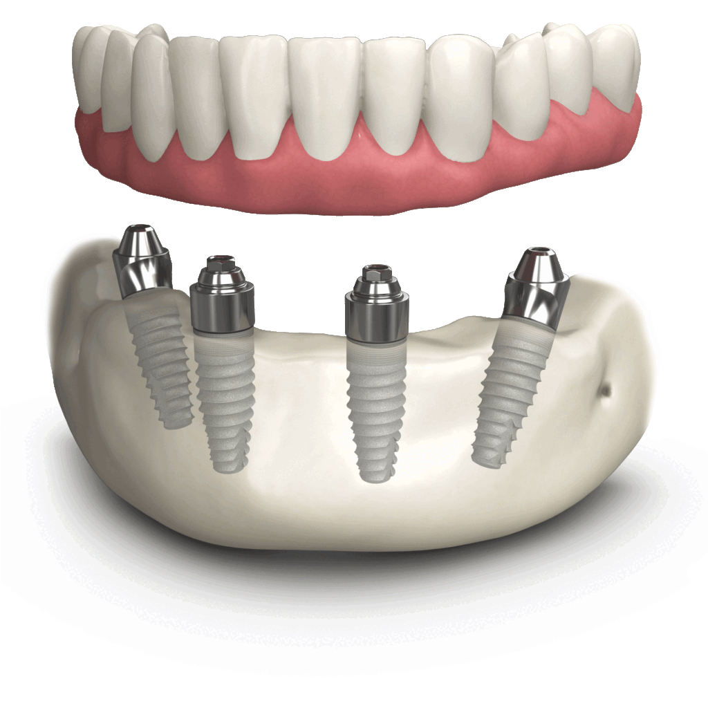 Graphic of All on 4 dental implant
